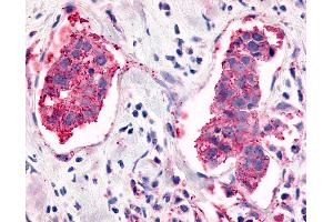 Anti-ELTD1 antibody IHC of human Breast, Carcinoma. (ELTD1 抗体  (C-Term))