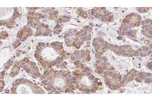 ABIN6272681 at 1/100 staining Human liver cancer tissue by IHC-P. (CCR4 抗体  (N-Term))