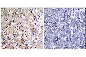 Immunohistochemical analysis of paraffin-embedded human breast carcinoma tissue using FKHR (phospho- Ser319) antibody (E011136). (FOXO1 抗体  (pSer319))