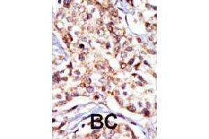 Formalin-fixed and paraffin-embedded human cancer tissue reacted with SRC polyclonal antibody  , which was peroxidase-conjugated to the secondary antibody, followed by DAB staining.