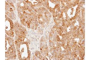 IHC-P Image Immunohistochemical analysis of paraffin-embedded N87 xenograft, using SLC25A13, antibody at 1:500 dilution. (slc25a13 抗体)