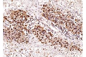 IHC analysis of Aurora A/AURKA using anti-Aurora A/AURKA antibody (ABIN7599581).