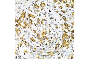 Immunohistochemistry of paraffin-embedded human gastric cancer using TAPBP Antibody. (TAPBP 抗体)