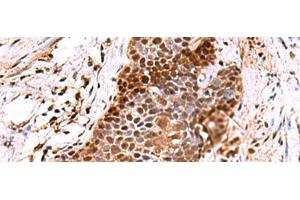 Immunohistochemistry of paraffin-embedded Human esophagus cancer tissue using POLD2 Polyclonal Antibody at dilution of 1:60(x200) (POLD2 抗体)