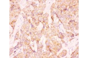 IHC-P: AAMP antibody testing of human breast cancer tissue (AAMP 抗体  (AA 235-434))