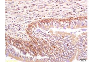 Formalin-fixed and paraffin embedded human lung carcinoma labeled with Rabbit Anti Phospho-Talin (Ser425) Polyclonal Antibody, Unconjugated  at 1:200 followed by conjugation to the secondary antibody and DAB staining