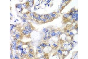 Immunohistochemistry of paraffin-embedded Human liver cancer using PNLIP Polyclonal Antibody at dilution of 1:100 (40x lens). (PNLIP 抗体)