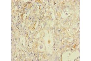 Immunohistochemistry of paraffin-embedded human lung cancer using ABIN7170802 at dilution of 1:100 (STOML2 抗体  (AA 29-356))