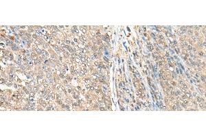 Immunohistochemistry of paraffin-embedded Human liver cancer tissue using ASS1 Polyclonal Antibody at dilution of 1:35(x200) (ASS1 抗体)