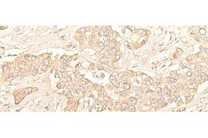 Immunohistochemistry of paraffin-embedded Human liver cancer tissue using DIMT1 Polyclonal Antibody at dilution of 1:30(x200) (DIMT1 抗体)