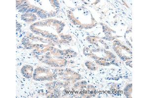 Immunohistochemistry of Human colon cancer using ALDH1A2 Polyclonal Antibody at dilution of 1:60 (ALDH1A2 抗体)