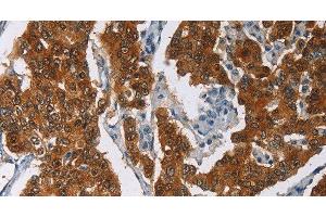 Immunohistochemistry of paraffin-embedded Human breast cancer tissue using CRABP2 Polyclonal Antibody at dilution 1:40 (CRABP2 抗体)