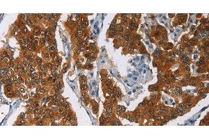 Immunohistochemistry of paraffin-embedded Human breast cancer tissue using CRABP2 Polyclonal Antibody at dilution 1:40 (CRABP2 抗体)