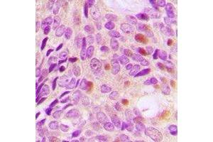 Immunohistochemical analysis of DLGAP5 staining in human breast cancer formalin fixed paraffin embedded tissue section. (DLGAP5 抗体)