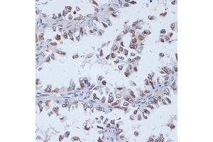 Immunohistochemistry of paraffin-embedded human lung cancer using DNMT3L antibody (ABIN3023228, ABIN3023229, ABIN3023230 and ABIN6219498) at dilution of 1:100 (40x lens).