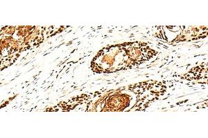 Immunohistochemistry of paraffin-embedded Human esophagus cancer tissue using H1FX Polyclonal Antibody at dilution of 1:30(x200)