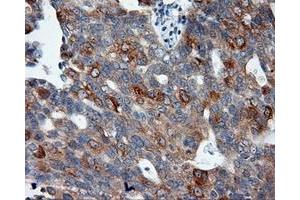 Immunohistochemical staining of paraffin-embedded Adenocarcinoma of colon tissue using anti-SIL1 mouse monoclonal antibody. (SIL1 抗体)