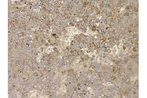 ABIN6255046 and ABIN6267160 at 1/100 staining human melanoma by IHC-P. (PRAS40 抗体  (pSer183))