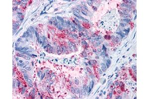 Anti-GPR82 antibody IHC of human Colon, Carcinoma. (GPR82 抗体  (Cytoplasmic Domain))