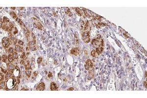 ABIN6279058 at 1/100 staining Human liver cancer tissue by IHC-P. (CHRNG 抗体  (N-Term))