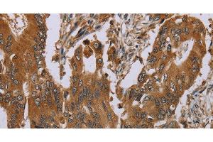 Immunohistochemistry of paraffin-embedded Human colon cancer tissue using OSM Polyclonal Antibody at dilution 1:40 (Oncostatin M 抗体)