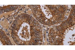 Immunohistochemistry of paraffin-embedded Human colon cancer tissue using WDR83 Polyclonal Antibody at dilution 1:60 (MORG1 抗体)