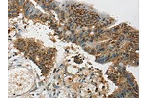 The image on the left is immunohistochemistry of paraffin-embedded Human colon cancer tissue using ABIN7192709(SYCP1 Antibody) at dilution 1/35, on the right is treated with synthetic peptide. (SYCP1 抗体)