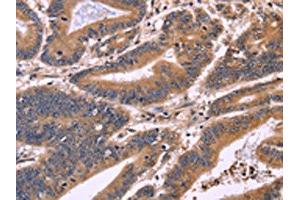 The image on the left is immunohistochemistry of paraffin-embedded Human colon cancer tissue using ABIN7130954(S100A13 Antibody) at dilution 1/40, on the right is treated with fusion protein. (S100A13 抗体)