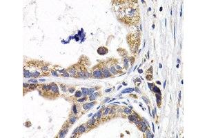 Immunohistochemistry of paraffin-embedded Human stomach cancer using FABP3 Polyclonal Antibody at dilution of 1:200 (40x lens). (FABP3 抗体)