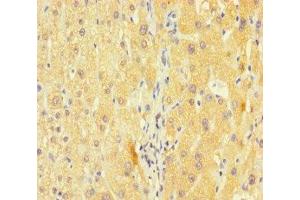 Immunohistochemistry of paraffin-embedded human liver cancer using ABIN7163953 at dilution of 1:100 (Kv1.6/KCNA6 抗体  (AA 1-171))