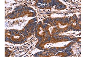 The image on the left is immunohistochemistry of paraffin-embedded Human colon cancer tissue using ABIN7129993(KIR2DL3/KIR2DL1/KIR2DL4/KIR2DS4 Antibody) at dilution 1/30, on the right is treated with fusion protein.