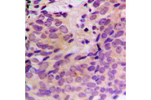 Immunohistochemical analysis of CERKL staining in human prostate cancer formalin fixed paraffin embedded tissue section. (CERKL 抗体  (Center))