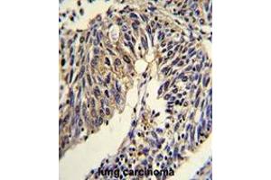 Formalin-fixed and paraffin-embedded human lung carcinoma reacted with TNFRSF14 Antibody (Center), which was peroxidase-conjugated to the secondary antibody, followed by DAB staining. (HVEM 抗体  (Middle Region))
