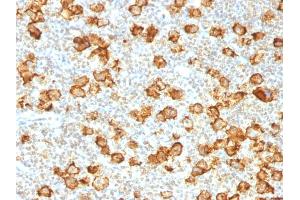 Formalin-fixed, paraffin-embedded human Hodgkin's Lymphoma stained with CD30 Rabbit Recombinant Monoclonal Antibody (Ki-1/1505R). (Recombinant TNFRSF8 抗体)