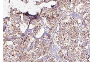 ABIN6275436 at 1/100 staining Human breast cancer tissue by IHC-P. (RAB3GAP2 抗体  (Internal Region))