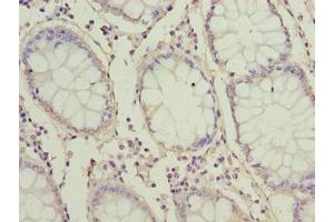 Immunohistochemistry of paraffin-embedded human colon cancer using ABIN7166380 at dilution of 1:100