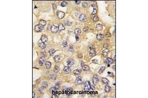 Formalin-fixed and paraffin-embedded human hepatocarcinoma tissue reacted with PFKM antibody (C-term), which was peroxidase-conjugated to the secondary antibody, followed by DAB staining. (PFKM 抗体  (C-Term))