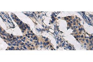 Immunohistochemistry of paraffin-embedded Human breast cancer tissue using COL17A1 Polyclonal Antibody at dilution of 1:50(x200) (COL17A1 抗体)