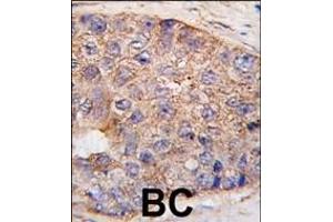 Formalin-fixed and paraffin-embedded human breast carcinoma tissue reacted with UBTD1 Antibody (C-term ) (ABIN387937 and ABIN2844471) , which was peroxidase-conjugated to the secondary antibody, followed by DAB staining. (UBTD1 抗体  (C-Term))