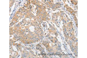 Immunohistochemistry of Human gastric cancer using APOBEC3G Polyclonal Antibody at dilution of 1:30 (APOBEC3G 抗体)