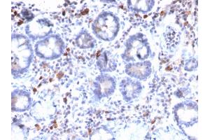 Formalin-fixed, paraffin-embedded human Gastric Carcinoma stained with MUC3 Rabbit Recombinant Monoclonal Antibody (MUC3/2992R). (Recombinant MUC3A 抗体)