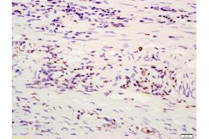 Formalin-fixed and paraffin embedded human rectal carcinoma labeled with Anti-ATF4/CREB-2 Polyclonal Antibody, Unconjugated (ABIN687862) at 1:200 followed by conjugation to the secondary antibody and DAB staining (ATF4 抗体  (AA 251-351))
