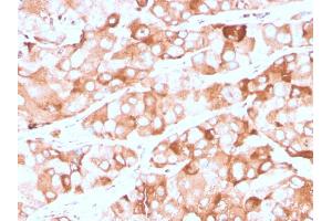 Formalin-fixed, paraffin-embedded human breast carcinoma stained with Prolactin Receptor Recombinant Mouse Monoclonal Antibody (rPRLR742). (Recombinant Prolactin Receptor 抗体)