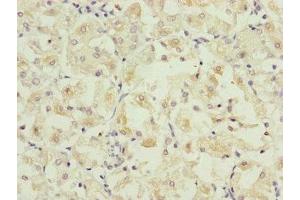 Immunohistochemistry of paraffin-embedded human gastric cancer using ABIN7162667 at dilution of 1:100 (PARD6B 抗体  (AA 253-372))