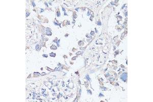Immunohistochemistry of paraffin-embedded human lung cancer using MTOR antibody.