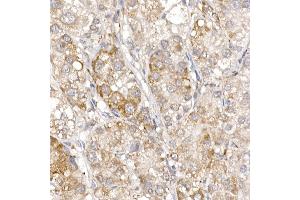 Immunohistochemistry of paraffin-embedded human liver cancer using Sterol carrier protein 2 Rabbit mAb (ABIN7270597) at dilution of 1:100 (40x lens). (SCP2 抗体)