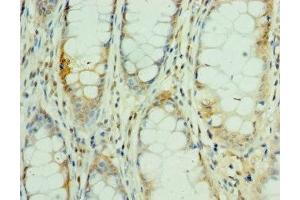 Immunohistochemistry of paraffin-embedded human colon cancer using ABIN7160505 at dilution of 1:100 (MEF2C 抗体  (AA 170-380))