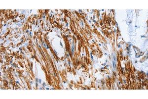 Immunohistochemistry of paraffin-embedded Human colon cancer tissue using SHROOM2 Polyclonal Antibody at dilution 1:50 (SHROOM2 抗体)