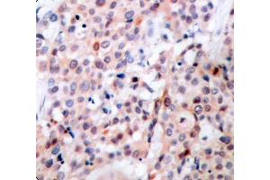Immunohistochemistry (IHC) image for anti-B-Cell CLL/lymphoma 2 (BCL2) (pThr56) antibody (ABIN1681414) (Bcl-2 抗体  (pThr56))