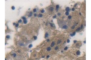 Detection of ALDH1A1 in Human Lung cancer Tissue using Polyclonal Antibody to Aldehyde Dehydrogenase 1 Family, Member A1 (ALDH1A1) (ALDH1A1 抗体  (AA 2-501))